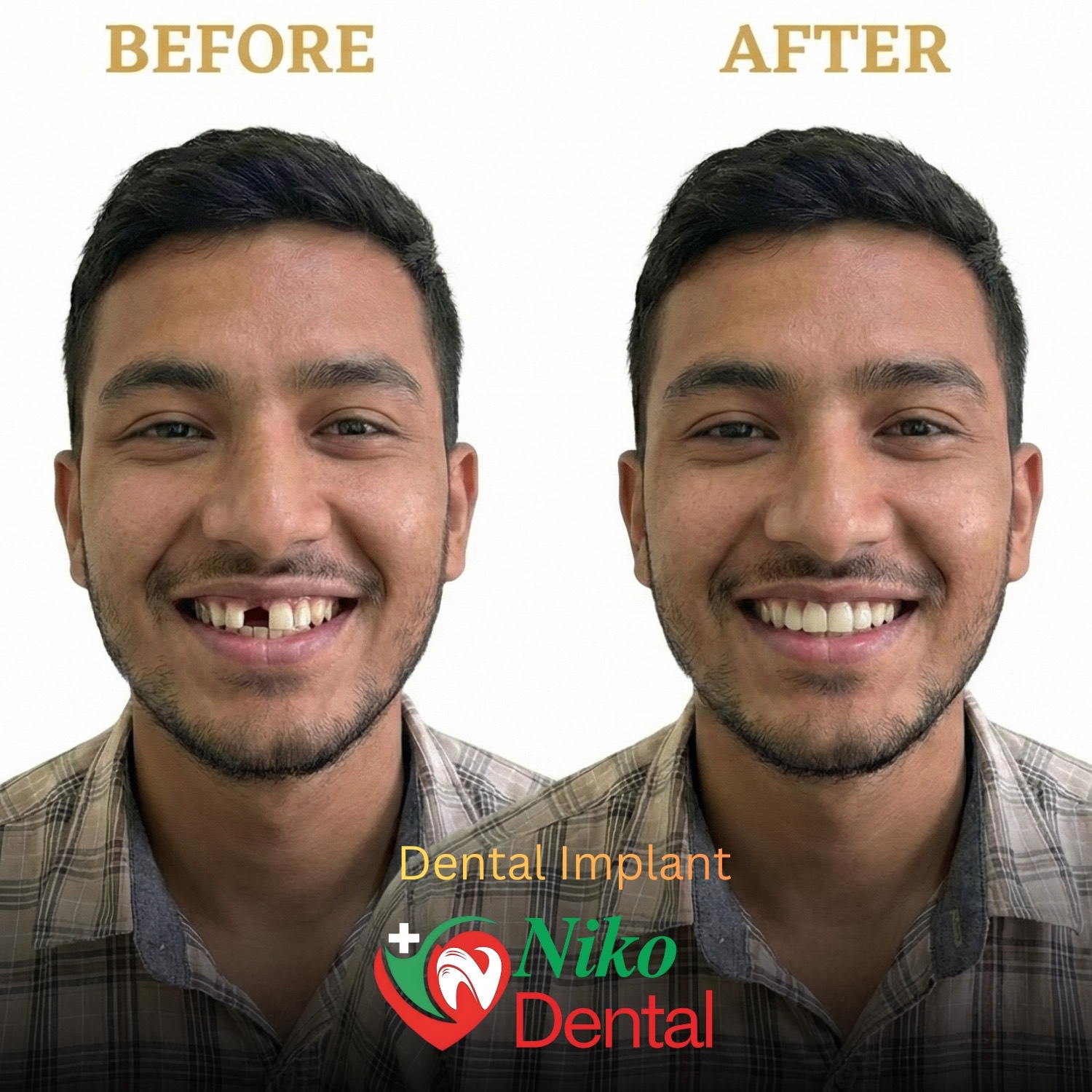 Before and after dental implant at Niko Dental Dhangadhi