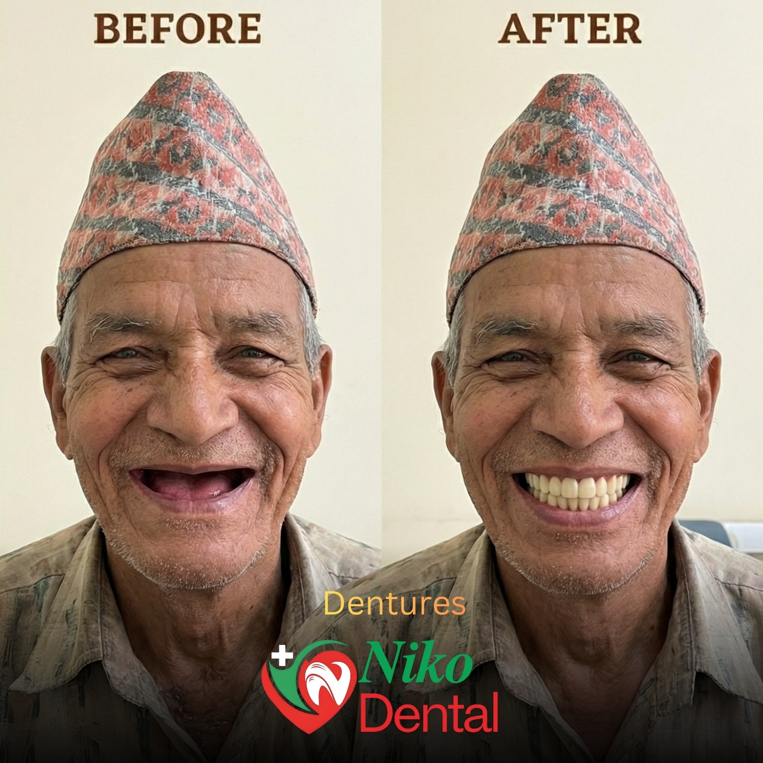 Before and after dentures at dental clinic Dhangadhi