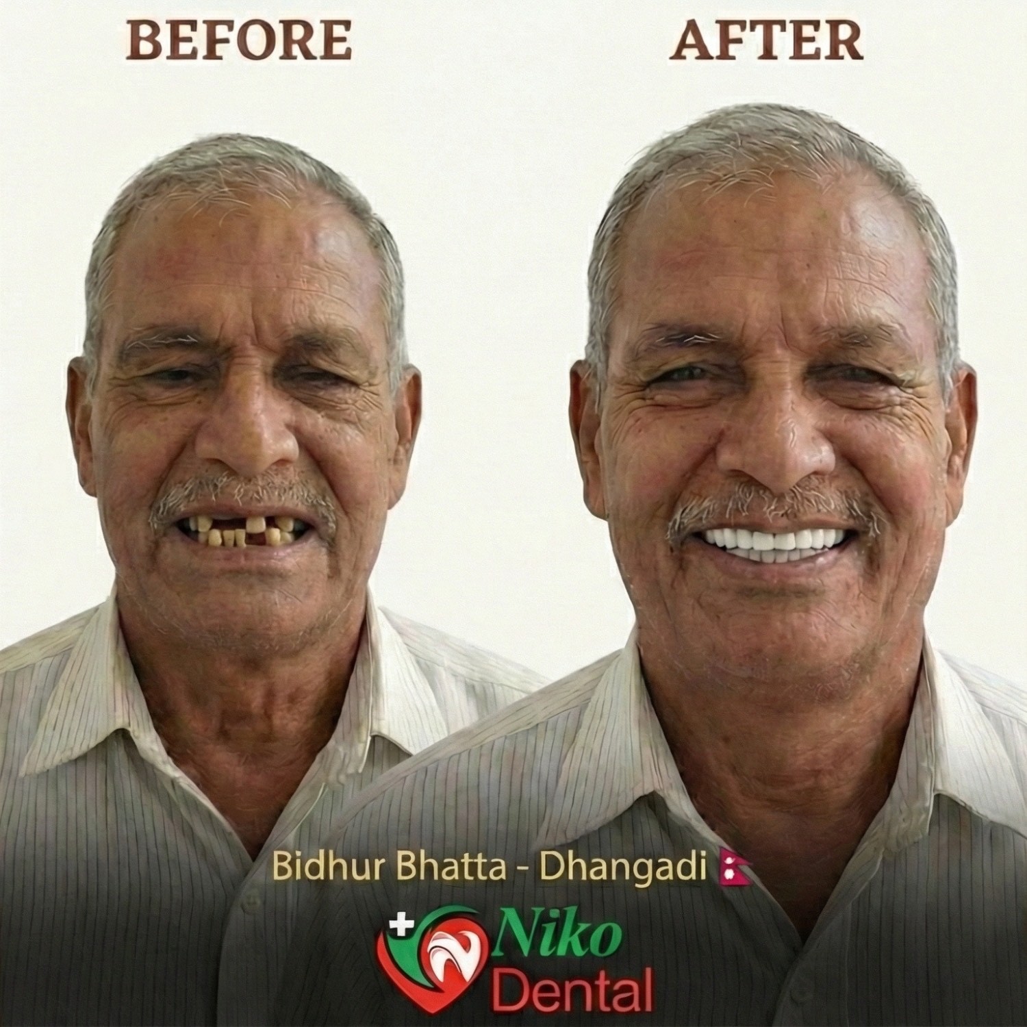 Before and after full mouth rehabilitation Dhangadhi