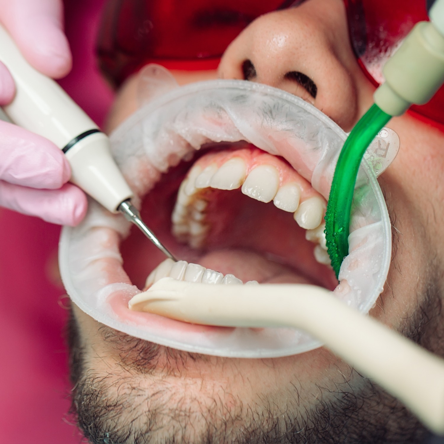 Teeth whitening in Dhangadhi