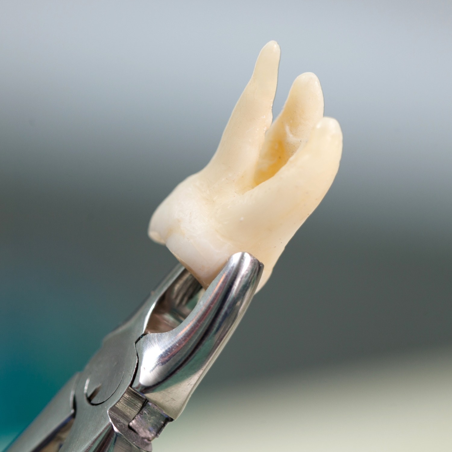 Tooth extraction service at Niko Dental Dhangadhi