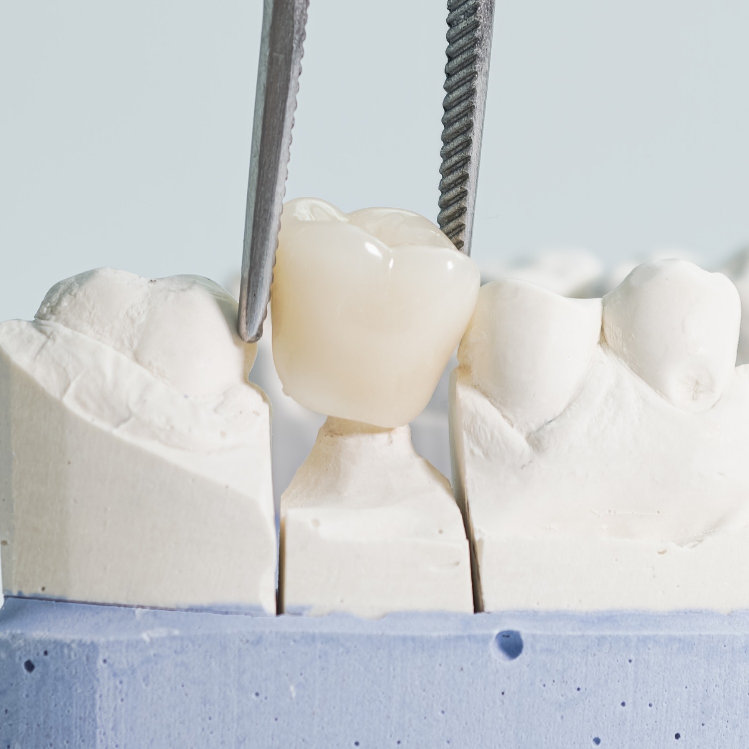 Zirconia crown dental service at Niko Dental Dhangadhi